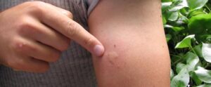 Puntura di zanzara nel braccio