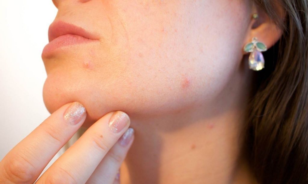 Acne su un volto femminile