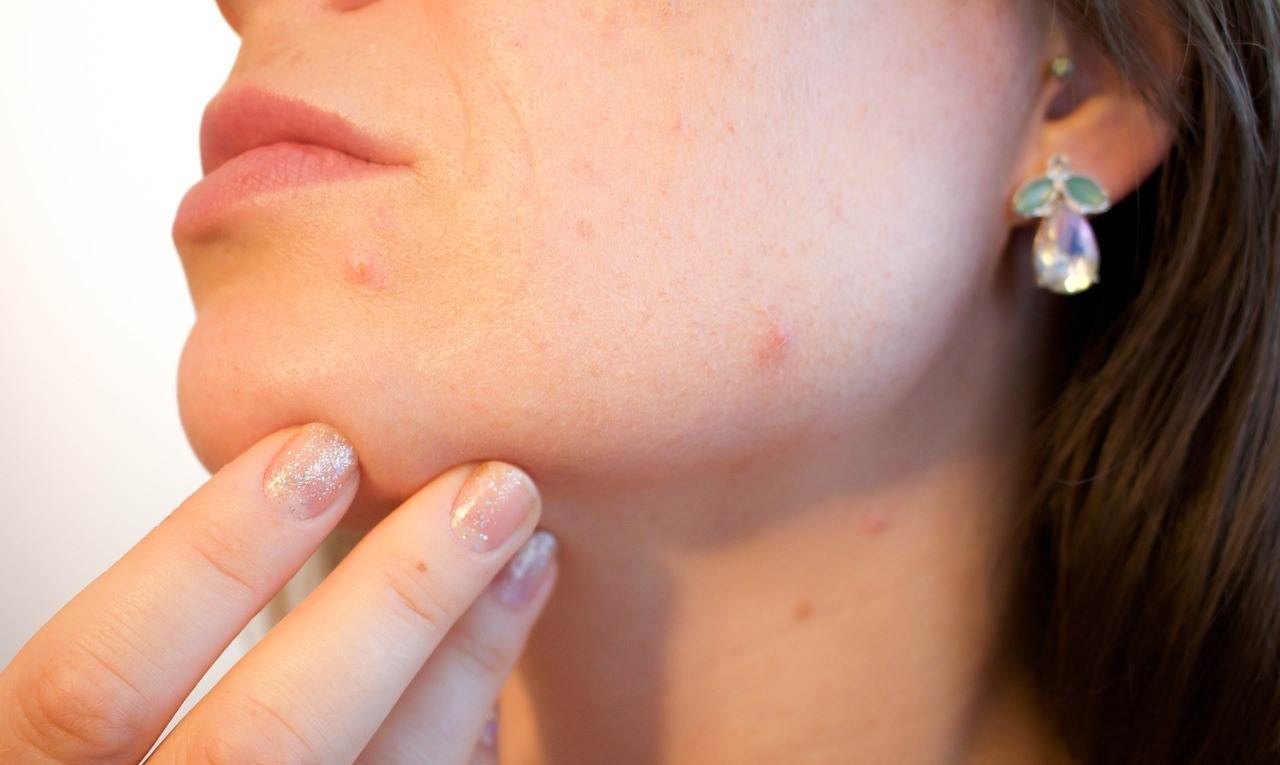Acne su un volto femminile