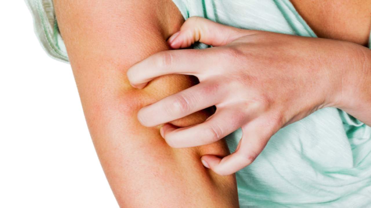 Una donna si gratta il braccio morso da una zanzara