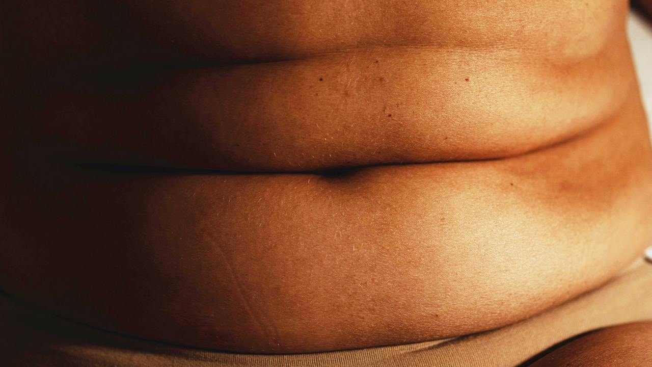 Obesità, persona obesa